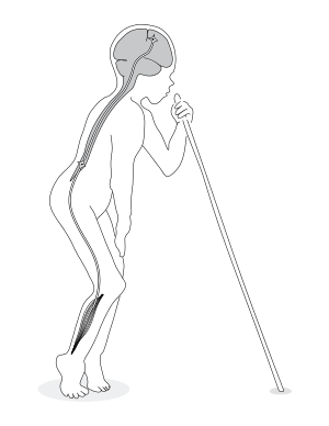 Signs and symptoms of Konzo