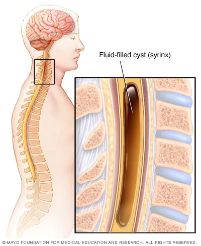 A syrinx is a fluid-filled neuroglial cavity within the spinal cord, in the brain stem, or in the nerves of the elbow
